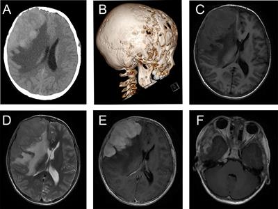 Rosai–Dorfman disease of the central nervous system: A clinical, radiological, and prognostic study of 12 cases
